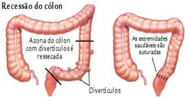 Diverticulite