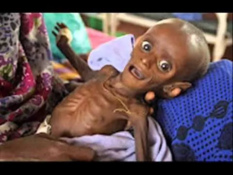 Resultado de imagem para fome na Ã¡frica 2017